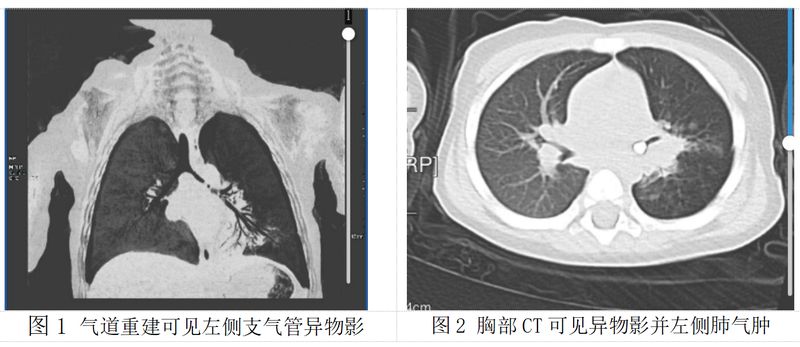  1岁宝宝误呛乳牙，反复肺炎50天！春节气道异物防护指南，家长必看 新闻