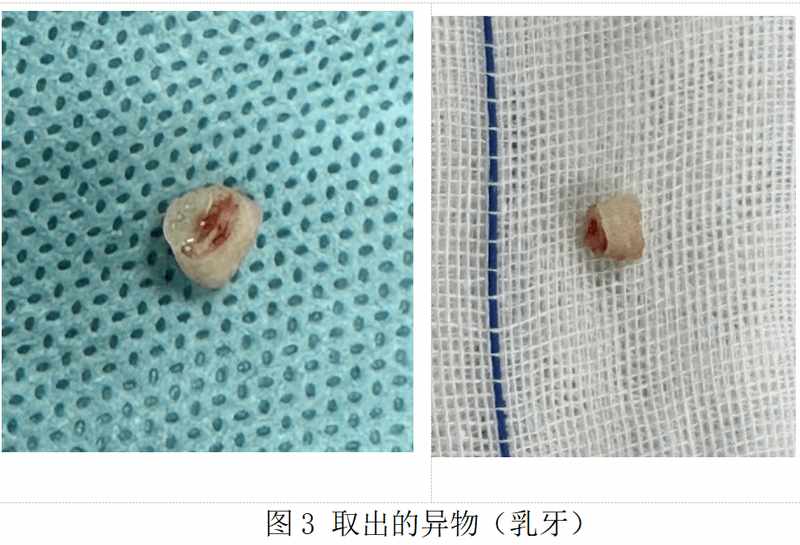  1岁宝宝误呛乳牙，反复肺炎50天！春节气道异物防护指南，家长必看 新闻